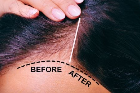 Role in Hair Loss